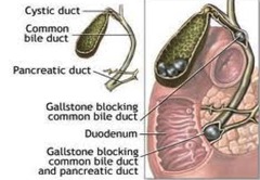 obstructive causes of acute pancreatitis