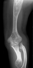 Ollier Disease. Note the many enchondromas. This disease has caused deformity in the proximal limb.