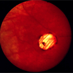 ON coloboma (otherwise looks like hypertrophic RPE with lacunae)