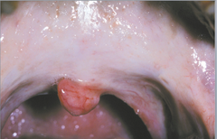 Oral Submucous fibrosis