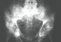 Osteoblastic Metatasis
