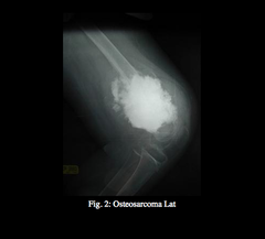 Osteosarcoma Symptoms  Diagnosis