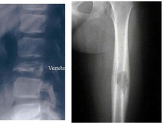 Osteosarcoma Treatment