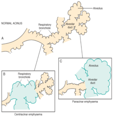 Panacinar emphysema