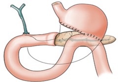 Pancreatic Adenocarcinoma Treatment