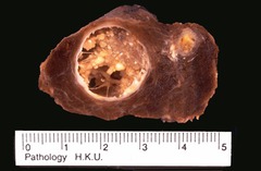 Papillary carcinoma of thyroid gross features