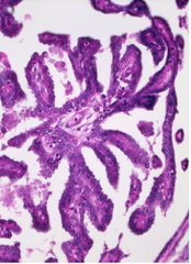 Papillary carcinoma of thyroid histology