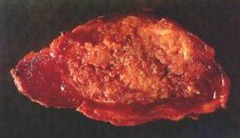 papillary carcinoma of thyroid