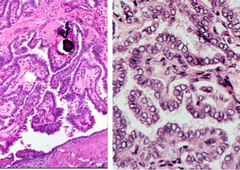 papillary carcinoma