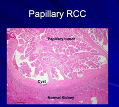 Papillary Renal cell carcinoma:  -What is it? -how does it usually present (focally and laterally)?
