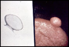 papule, nodule or tumor that has an attachment to the normal oral mucosa which is smaller than the greatest diameter of the lesion itself; attached by a stalk