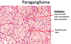 paraganglioma