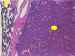 parathyroid adenoma-histo