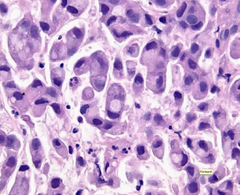 Pathological features of X cancer on histology? Name of cell? Name of tissue change? What happens to the nuclei?