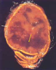 PCC of the adrenal medulla