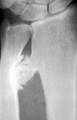 Pedunculated Osteochondroma causing mechanical irritation. It formed a pseudo-joint (adventitious joint) which underwent degenerative joint disease. Note presence of osteophytes.