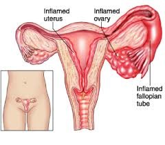 Pelvic inflammatory disease can cause ectopic pregnancy.