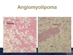 pics of angiomyolipoma
