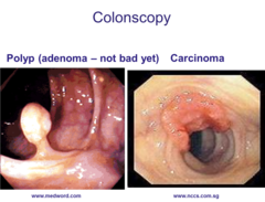 Premalignant tumors (colon cancer)