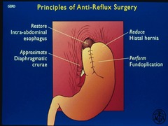 principles of anti-reflux surgery