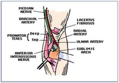 Pronator teres syndrome