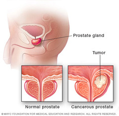 Prostate cancer drugs