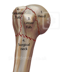 Proximal humeral fracture