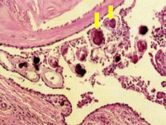 Psammoma bodies of papillary carcinoma