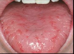 Psoriasis in the mouth