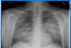 Pulmonary Hemorrhage