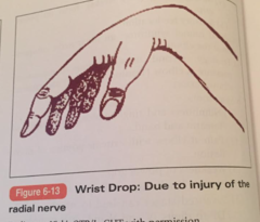 Radial Nerve Laceration: Deformity?