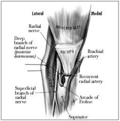 Radial tunnel syndrome