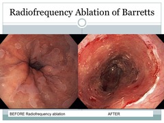 Radiofrequency Ablation for Barretts