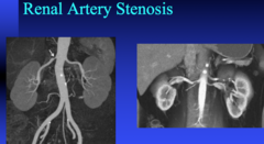 renal artery stenosis