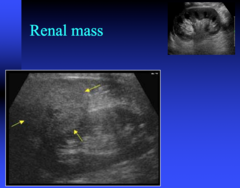 renal mass on US