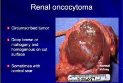 Renal oncocytoma  -benign or malignant? -gross appearance?