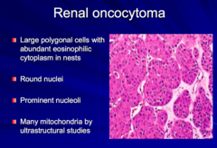 Renal oncocytoma - histo