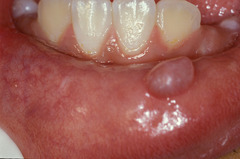 Retention Mucocele