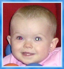 Retinoblastoma  Symptoms