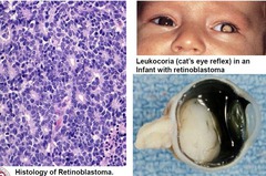 Retinoblastoma