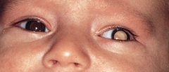 Retinoblastoma Medical Management