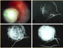 Retinoblastoma Staging