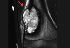 Retinoblastoma What is it