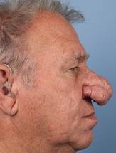 rhinophyma resulting from rosacea