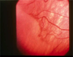 ROP stage 1 (line of demarcation separates the more nasal vascular zone from the more temporal avascular zone)