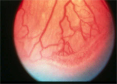 ROP stage 3 (neovascularization, as a result of anoxia, occurs along the ridge)