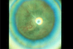 ROP stage 5 (total retinal detachment)