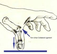 Rupture of the ulnar collateral ligament (UCL) of the thumb joint