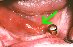 Salivary calculus