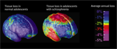 Schizophrenia Brain Abnormalities
